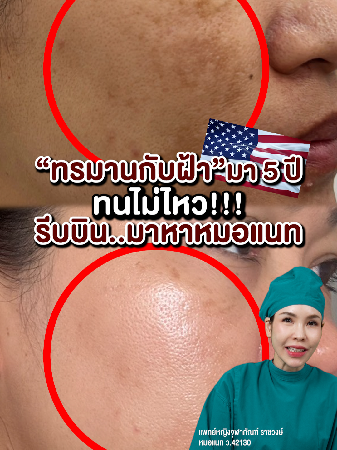 ทรมานกับฝ้ามา 5 ปี ทนไม่ไหว!! รีบบินมาหาหมอแนท #doctornat #ดอกเตอร์แนท #ฝ้า #จุดด่างขาว #ฝ้ากระ #ฝ้าแดด #จุดด่างดำ #ฉีดฝ้า #pico #รักษาฝ้าไม่ใช้ความร้อน #MISS #รักษาฝ้า #ไม่ขายคอร์ส #ไม่มีคอร์ส #ไม่เลี้ยงไข้ #เลเซอร์รักษาฝ้า #เซรั่มฝ้า #ครีมทาฝ้า #ยาฝ้า #วิตามินฝ้า #ไวท์เทนนิ่ง #ฉีดฝ้า