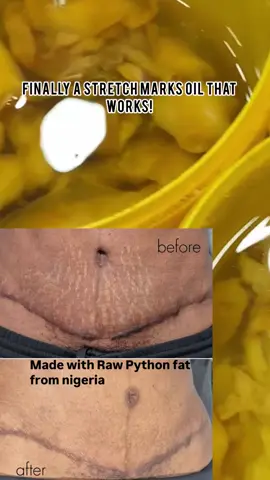 Nigerian  tradition. Real ingredients. Real results. Python fat oil for scars and stretch marks. #StretchMarkTreatment #NaturalSkincare #SkincareThatWorks #FadeStretchMarks #SkincareResults #AfricanSkincare #pythonfa 