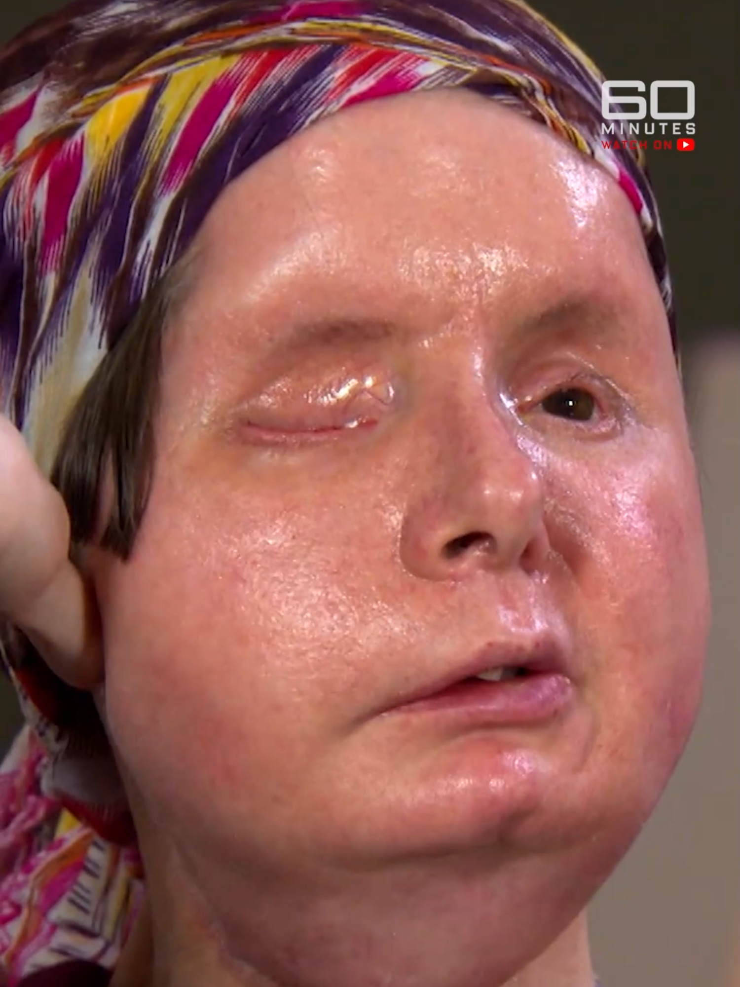 Watch the full story on the 60 Minutes Australia YouTube channel. Charla Nash was savagely attacked by a friend’s chimpanzee, leaving her fighting for life and with a body disfigured beyond recognition.