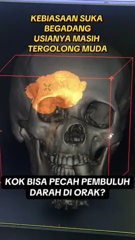 #ctscan #radiology #brain #stroke 