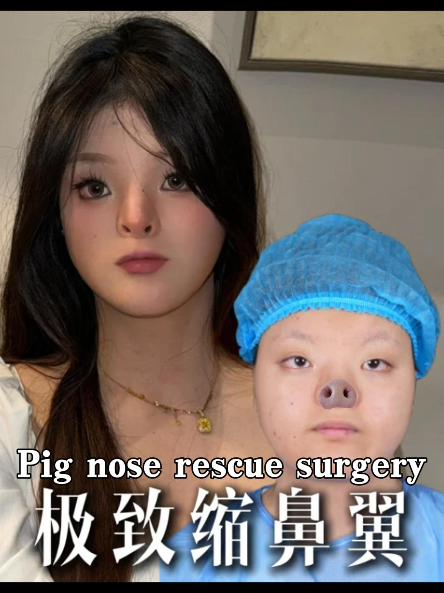 Pig nose rescue surgery🐽 #nose #Rhinoplasty #MedicalBeauty #sharethecare #鼻子 #鼻整形 #鼻综合 #隆鼻 #鼻修复 #改造 #整形 #fyp #案例分享