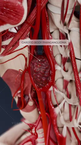 What is carotid body paraganglioma and how can it affect your health?   Carotid body paraganglioma is a rare tumor that arises from the chemoreceptor cells of the carotid body. While it is typically benign, this tumor may compress nearby blood vessels and nerves, leading to significant symptoms.   Common symptoms include: 🔻 Neck mass 🔻 Hoarseness 🔻 Difficulty swallowing (dysphagia) 🔻 Dizziness   Although benign, the tumor can lead to vascular and neurological issues if left untreated. Prompt diagnosis and intervention can prevent these risks.   The main treatments for carotid body paraganglioma are surgical excision, which involves removing the tumor, and preoperative embolization to reduce the risk of bleeding during surgery.   Early detection is crucial to prevent complications and ensure proper treatment planning for improved outcomes.   📌 Dive deeper into carotid body paraganglioma and related anatomy with VOKA 3D Anatomy & Pathology!   #paraganglioma #carotidbodyparaganglioma #tumortreatment #ENTpathology #3danatomy #medstudents #medicaleducation #anatomy #pathology #3danatomy #digitallearning #humanbody