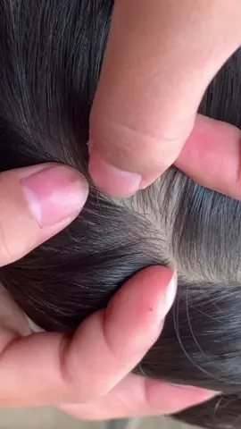 😱😱#omg #lice #liceremoval 