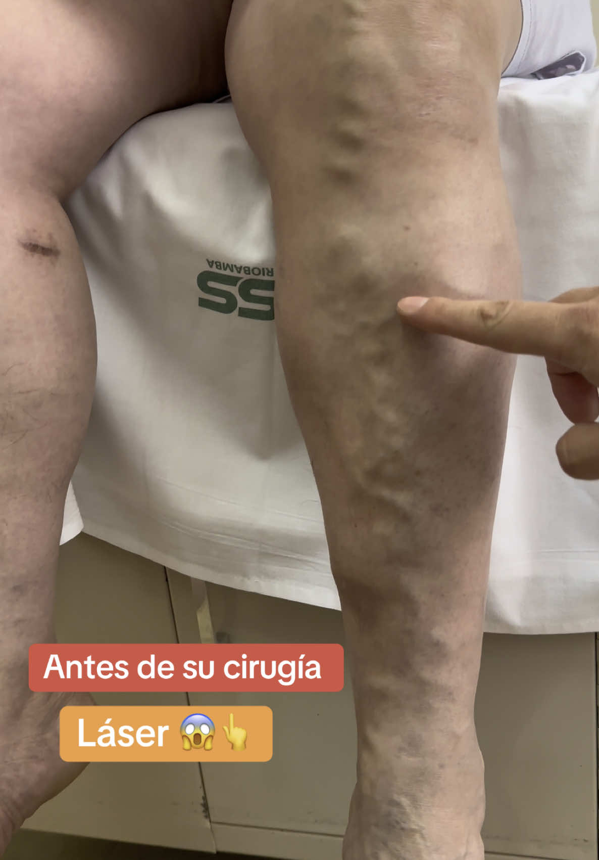 🏩 La Cirugía de Várices con Láser ☺️👆 es la mejor elección para eliminar las Várices de tus piernas 🥰 Te vas caminando a tu casa luego de la cirugía , no lleva cortes , no deja cicatrices, tiene excelentes resultados @The Vein Doctor 👨‍⚕️ 👉 Riovasc 👈📲+593995178395/+593958757917 #varices #varicesenlaspiernas #venasvaricosas #arañasvasculares #varicesyarañitas #varicesgrandes #cristianbravo148 #cirugiavascular 