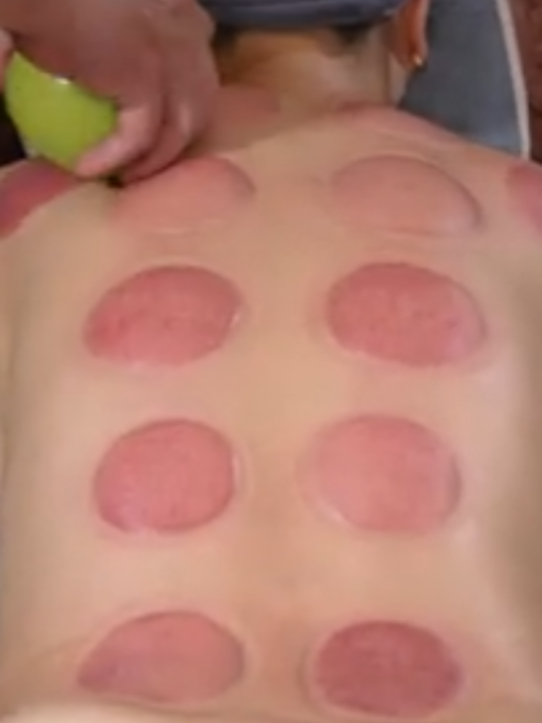 VIP cupping masage  #massagetherapy #asmrvideo  #cupping #asmrsounds 