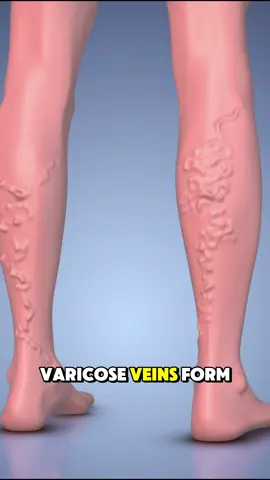 How Varicose Veins Forms? (3D Animation) #varicoseveins #varicoseveintreatment #varicosetreatment #varicosevein #varicoseveinremoval #medical3danimation #3dmedicalanimation 