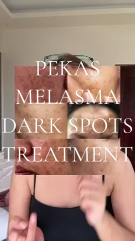 Replying to @fatimah0307 PEKAS MELASMA DARKSPOTS #melasma #melasmatreatment #freckles #pekas 