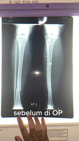 haii aku alumni fraktur Tibia closed. aku jalur operasi :  1 Bulan pertama pasca OP pake dua tongkat 2 bulan pasca OP pake satu tongkat  3 bulan pasca OP aku lepas tongkat  9 bulan pasang pen abis itu dilepas.  Sekarang alhamdulillah ga pincang atau keluhan lainnya, yang bantu aku sembuh aku rutin minum susu yang tinggi kalsium.  kalo suka konten aku jangan lupa like, comment yaa. semangattt para frakturrr 💖 #fraktur #frakturtibia 
