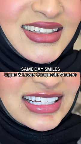 A new smile in 3 hours! DM to book your consultation today! #compositeveneers #samedaysmile #compositebonding 