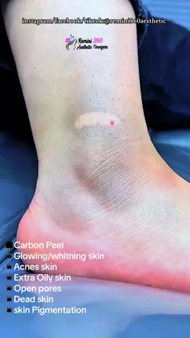 carbon peel Laser Treatment Acne Scars Removal, Glowing Skin By Carbon Peel Carbon Peel Have you not heard of HOLLYWOOD PEEL or Carbon Peel !!!! One of the most vital element amongst celebs beauty regimes. یہ آپ کی جلد کی سب سے اوپری تہہ کو خارج کر دیتا ہے اور اس طرح فوری چمک دیتا ہے۔   👉 مہاسوں کو کم کرنے میں مدد کرتا ہے کیونکہ لیزر چھیدوں میں موجود تمام بیکٹیریا 🦠 کو بھی مار دیتا ہے۔   👉 چھیدوں کو سکڑتا ہے۔   👉 پگمنٹیشن میں مدد کرتا ہے۔   👉آخر میں، کولیجن کو سخت کرنا- باریک لکیروں کو کم کرتا ہے۔   👉 مردوں اور عورتوں دونوں کے لیے کام کرتا ہے۔ 👉 It exfoliates and removes the upper most layer of your skin thus, giving instant radiance  👉 helps reduce acne as laser kills all the bacteria 🦠 in the pores too.  👉 shrinks pores  👉helps with pigmentation  👉lastly, collagen tightening- reduces fine lines  👉works both for men & women  #viraltiktok #veiwsproblemsolvekrotiktok #foryoupageofficaltiktok #TheSkinsClinic #FacePRP #Microneedling #fyp #foryou #unfrezzmyaccount #viraltiktok #foryoupage #viralvideo #growmyaccount #trendingvideo #newtrend # #viewsproblem #dir #lowerdirytimergara #kpk #remini360aesthetic #aesthetic #foryou #foryoupage #fyp #fyp> #fypシ 