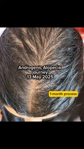 1 month of progress... this is just the beginning 🌿💫 #androgeneticalopecia #femalehairloss #hairlossjourney #alopeciaawareness #hairupdate #femalepatternbaldness #1monthprogress #hairlosscommunity #hairthinning #alopeciasupport #viral  #hairlosshelp #hairtransformation #fy #foryoupage❤️❤️ 