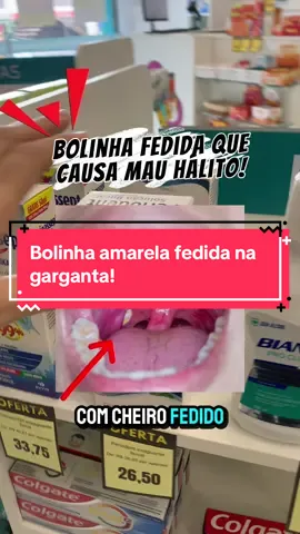Bolinha amarela fedida na garganta. O que é? Como tratar?#caseo #garganta #boca #gargantainflamada #cheiro #caseum #fyp #foryoupage #funny #football #remedioscaseros #remediosnaturales 