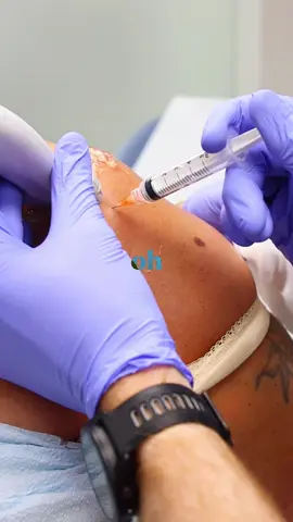 How to relieve shoulder pain from arthritis? A steroid injection helps reduce inflammation in the shoulder joint or surrounding tendons. It’s often used for rotator cuff issues, bursitis, or impingement — relieving pain and improving movement fast. #painmanagement #painrelief #arthritis 