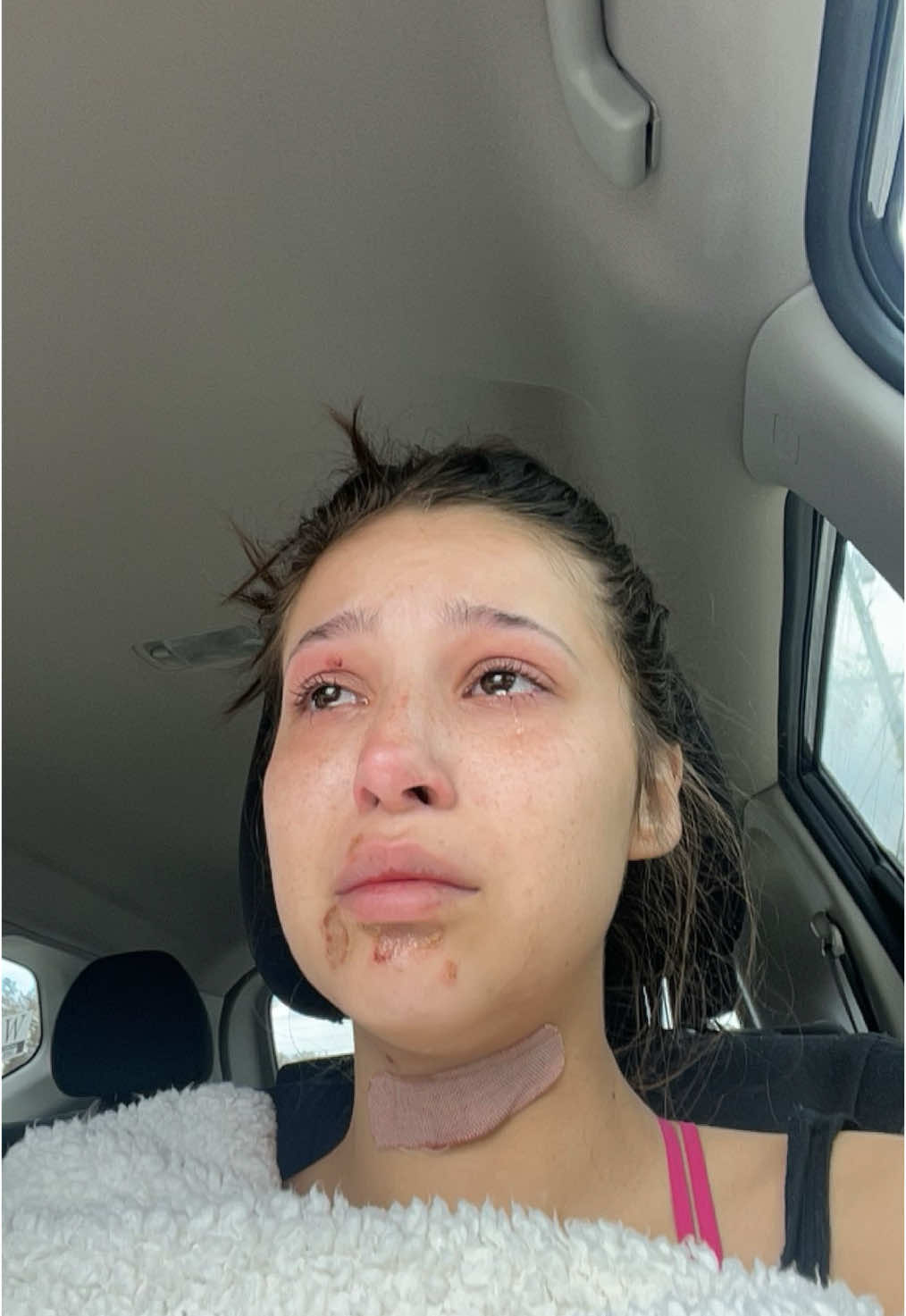 i never thought eczema would take over my life so much, i thought it was genuinely just dry skin. over time i was able to learn that it isn’t just your body but also mental health, stress, what you eat, and honestly everything. After suffering and realizing this i learned i had to put myself first remove myself from situations stop doing certain things but overall you can see the change in my skin and my happiness. It was a hard struggle and after tears and smiles i’ve finally been able to be at the best point in my life with my skin reflecting that. This has been a clear sign to me that everything you do and who you surround yourself with really reflects not only on your mental health but your physical health too. #warning #ihateeczema #eczema 
