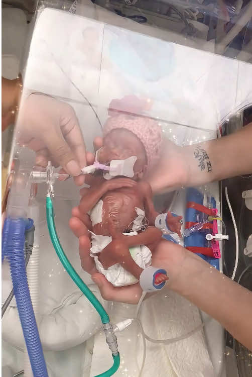 Premature baby birth just 18 weeks old #prematurebaby #birh#cutebaby #pregnant #18weekspregnant #usa #us 