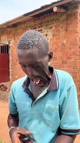 Please link in the bio to help Benard get surgery 😭 🙏 #disability #skinsurgery #surgery #disabled #burnt #firescars #hungry #hunger #benard @Taylor Swift @Khabane lame @Selena Gomez @Kylie Jenner @MrBeast 