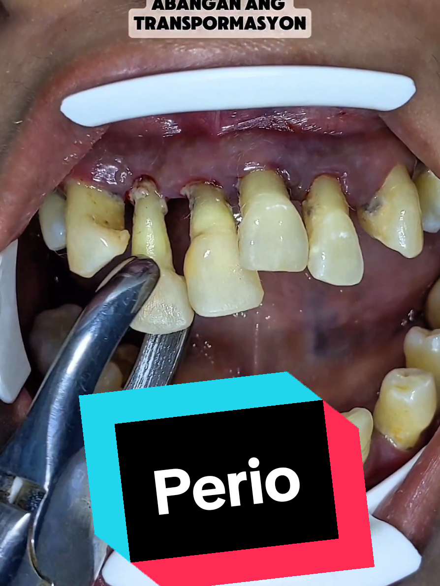 Periodontitis #educate #educational #FathersDay WAIT FOR PART 2  Have A Great Teeth Day! ✨🌟☺️