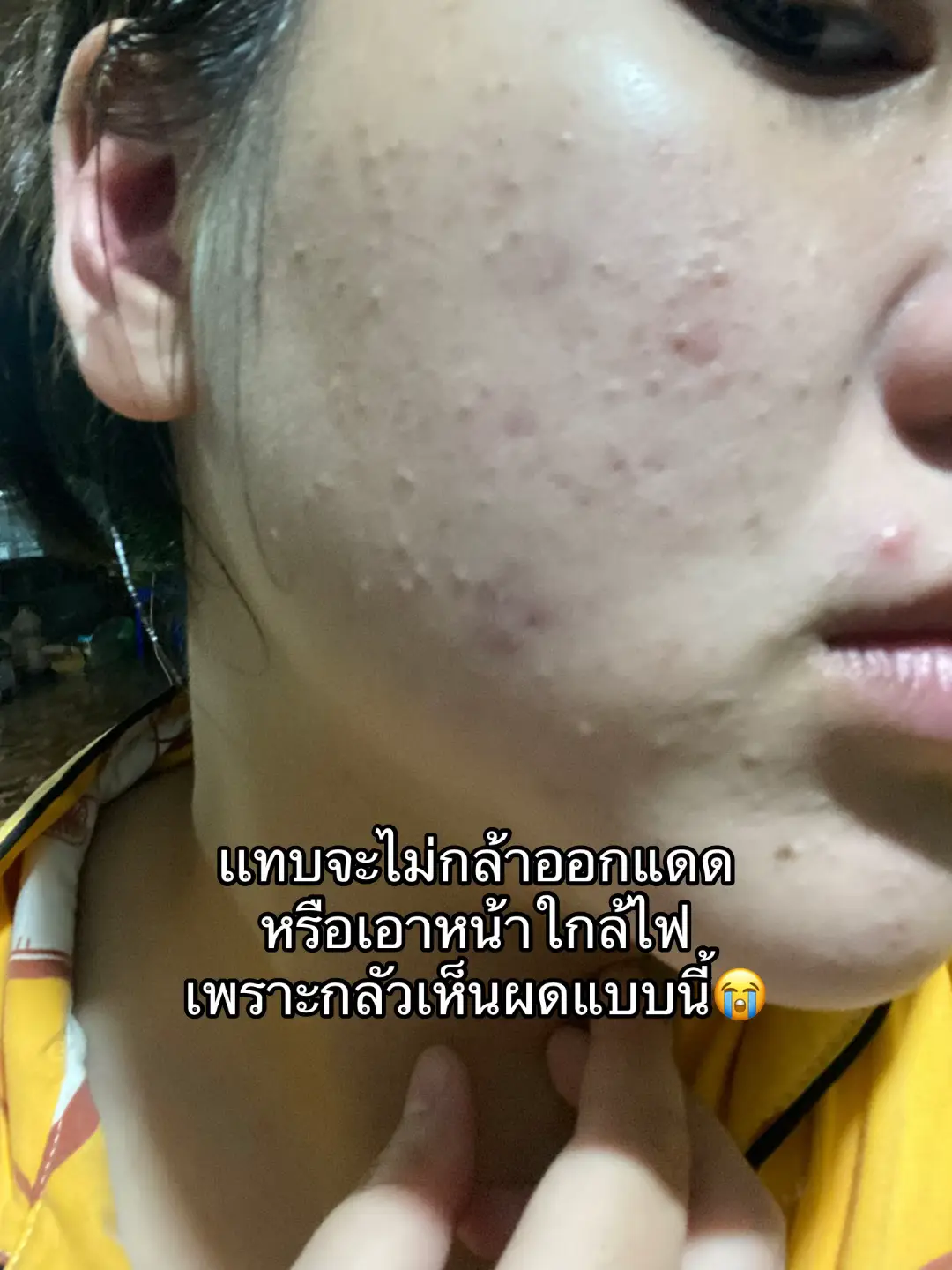 #Tiktokป้ายยา #ลดสิว #สิวผด #สิวผดขึ้นเต็มหน้า #สิวอุดตันหาย #สิวอุดตัน #สิวหาย #สกินแคร์ #ใช้ดีบอกต่อ #รีวิวบิวตี้ #mizumi #neutrogena #provamed #มอยซ์เลอโฉม 