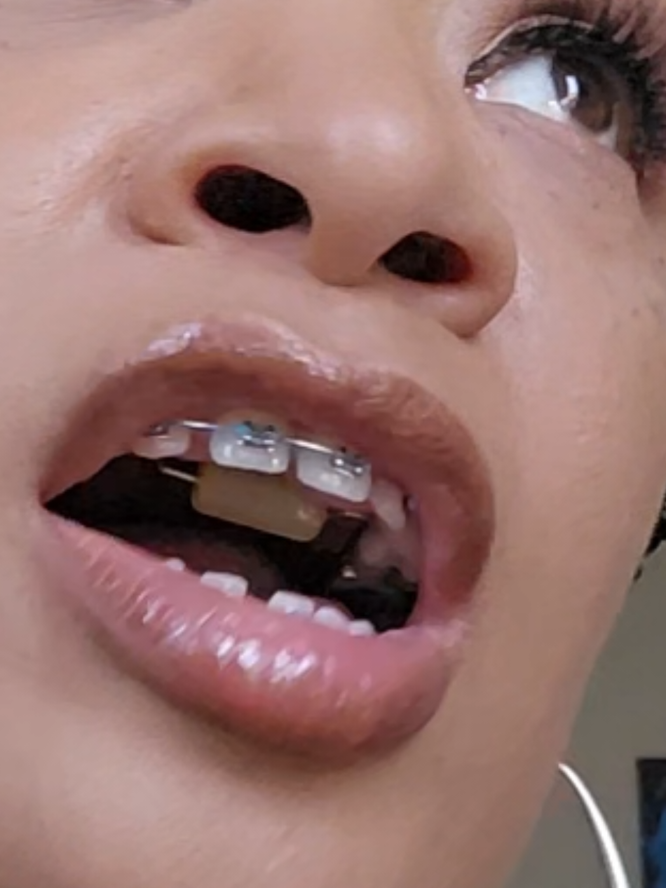 Bluegrass Appliance Update  #bracesjourney #blackgirlbraces #tonguethrust #bluegrassappliance #adultbraces #habitbreakingappliance #foryourpage