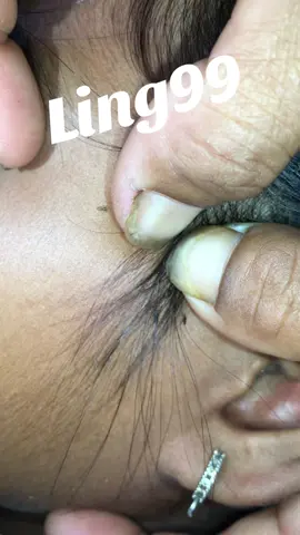 lice concentrated in one place#omg🤮🤮 #lice #liceremoval 