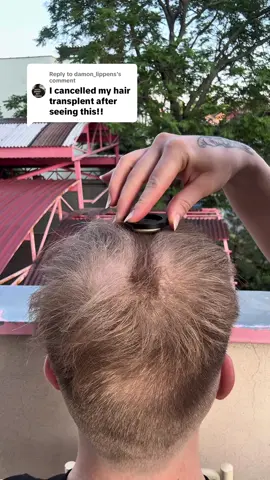 Replying to @damon_lippens why hair transplant when we have created root’d😏😮‍💨