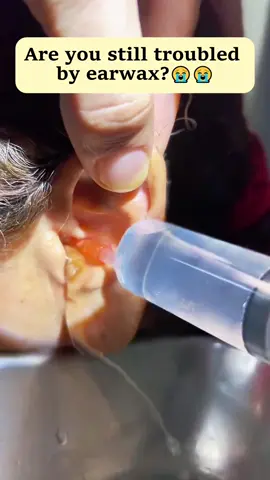Don't be afraid of ear stones. Look at this multi-functional visual ear scoop.#visual #earpicking #earwax #earwaxremoval #tiktokshop #visualearpicking #earpick 