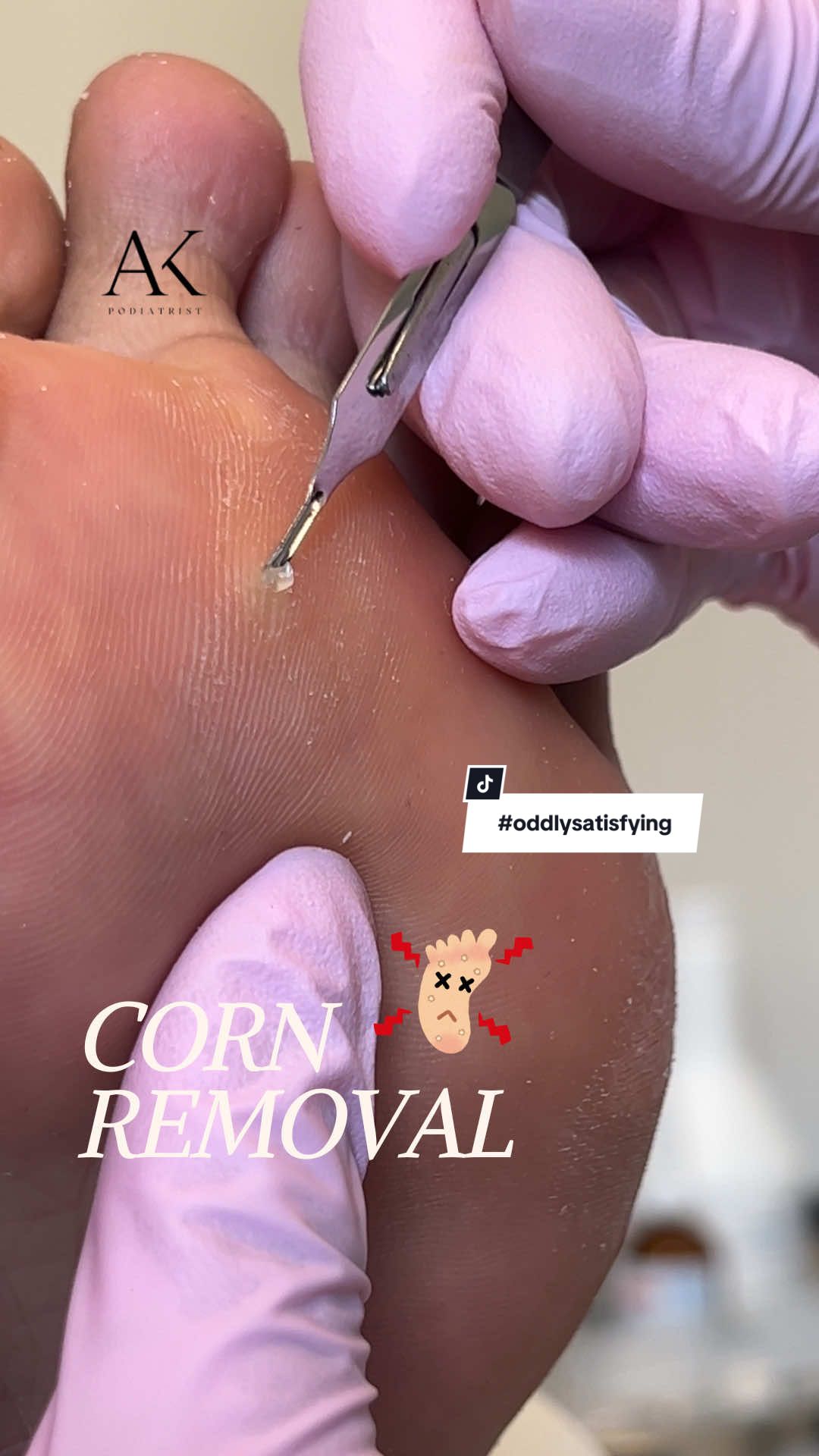 So satisfying to debride this painful corn👣🌽 If you’ve got a hard, sore spot on your foot that just won’t budge — it could be a corn! These are caused by pressure or friction, often from footwear or foot structure. 🩺 Aftercare tips: 🔸Moisturise daily with a urea-based cream.  🔸Wear properly fitted shoes.  🔸Avoid DIY blades – they can cause infections.  🔸Come in for regular medical maintenance if you’re prone to corns.  Book your professional corn removal – gentle, safe, and super effective. ⸻ 🌐 | www.amnapodiatrist.com 💌 | info@amnapodiatrist.com Consent obtained for videography & sharing.  #cornremoval #medicalpedicure #podiatryclinic #podiatristuk #footcaretips #edgbastonpodiatry  #healthyfeet #foothealthmatters #feettransformation #chiropody #corns #hardskinremoval #birminghampodiatrist #amnapodiatrist #oddlysatisfyingvideo 