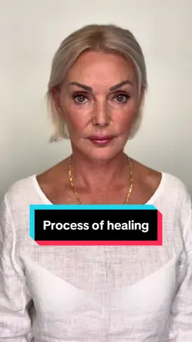 The process of healing after V lift, temporal brow lift and sashimi lip lift on my 62 y.o. patient 👌 1. Day of the surgery 2. Day 1 3. Day 8 4. Day 15  5. Day 49 All done under local anesthesia💪 📲 If you want to make an appointment, contact us at contact@v-clinic.cz #facelift #necklift #plasticsurgery #plasticsurgeon #ventruba #vclinic #transformation #beforeandafter