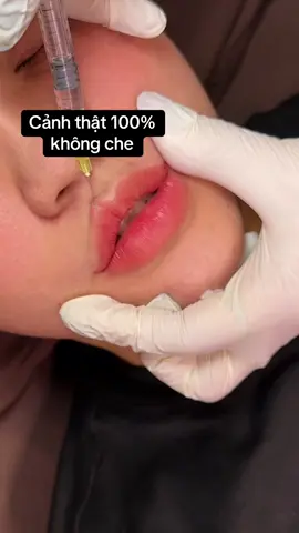 📸Cận cảnh dựng đỉnh môi đúng kỹ thuật – không đau, không sưng  💋” #tiêmmôi #fillerđẹp #môitráitim #BeautyTok #thẩmmỹtựnhiên #tiemmoi  