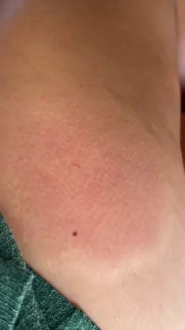 Got stung from a wasp yesterday for the first time ever & my leg looks worse 🤣 it’s hot and hard. The red area is much bigger then yesterday. Should I be concerned??🤔