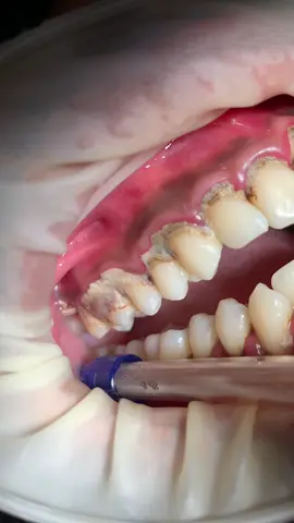 Dental scaling/pembersihan karang gigi. Siapa yang belum pernah skeling hayo? Yuk jadwalkan pembersihan karang gigi mu! #doktergigi #doktergigibandung #klinikgigi #klinikgigibandung #sikatgigi #karanggigi #asmr 