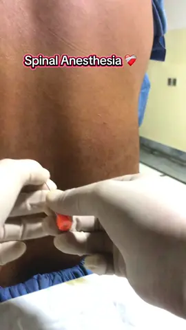 Spinal Anesthesia ❤️‍🩹 #surgicaltechnologist #foryouu #fyp #viralvideos #grow #nasirkhnx8 #💉 #💉💊🔬❤️👩‍⚕️ #ot #unfreezemyacount #500k @Medico🩺🥼 @Dr.Afridi 🩺 @Medico🥼🩺 