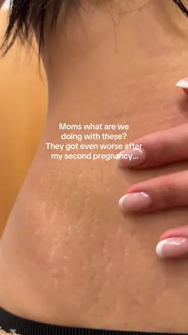 What are we doing with postpartum stretchmarks? Nothing works😫 #stretchmarks #postpartumbody #postpartum 