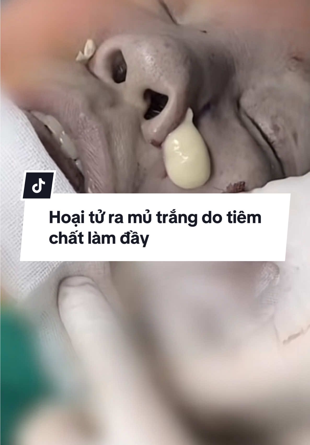 #suamuihong #xuhuongtiktok #PTTM #nguyenvanhieu 