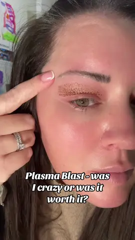 Plasma Blast results - zapping me with the plasma pen took a very short amount of time & cost me £450 - cheaper than an upper bleph surgery & obviously it’s not going to be as effective as surgery! But what do you think? #plasmapen #plasmablast #fibroplasma #plasma #uppereye #uppereyelid #eyelift #nonsurgical #results #beforeandafter #fyp #aesthetictreatments 