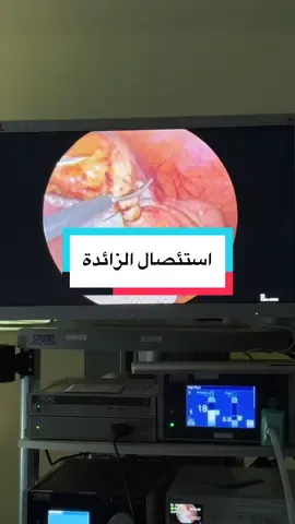 عملية استئصال الزائدة الدودية #زائدة_دودية #الزائدة_الدودية #جراح #جراحة_عامه #دكتور_سمير_رحماني #عمليات 
