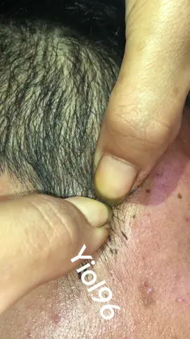 tiktokremixcontest#omg🙀🙀😱😱❤️ #lice #liceremoval 