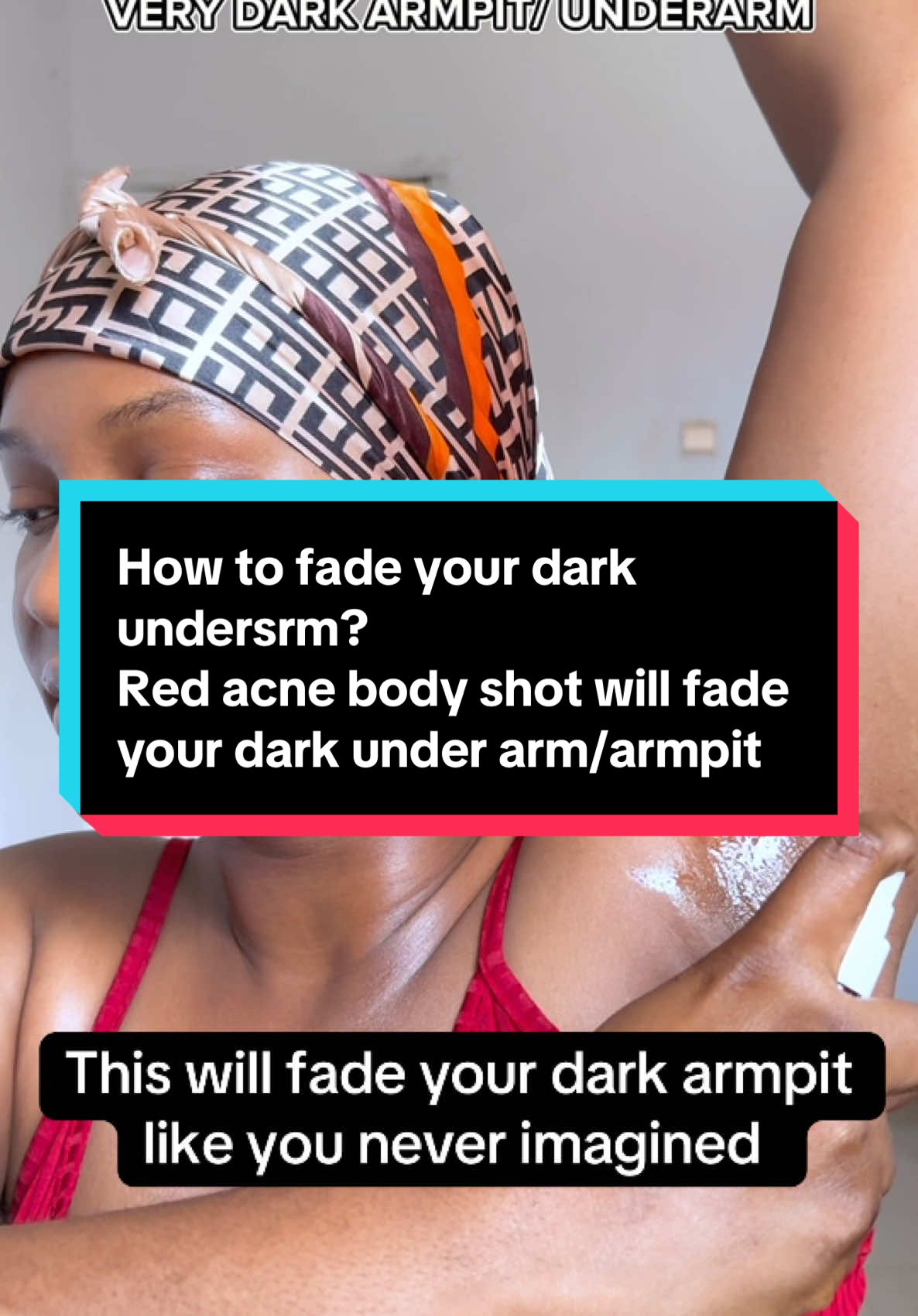Not gonna lie, my underarms have been through it 😩 Dark spots, hyperpigmentation   I’ve tried a lot. But This Medicube Red Acne Body Peeling Shot is one of the few things that’s actually helping to smooth out and get rid of my hyperpigmentation and dark under arms  If you’ve been dealing with dark underarms (or chicken skin too),and you need an 100 percent  effective product to achieve a better result for your dark under arm , you definitely need this in your routine  @medicube global  #medicube #redbodypeelingshot #bodycare #medicubeskincare #bodypeeling #exfoliate #chickenskin #underarmcare #ulta #darkunderarms #darkarmpits #hyperpigmentation #underarmskincare 