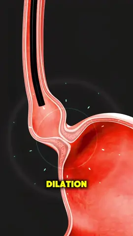 Achalasia Dilation Surgery (3D Animation) #achalasia #achalasiaawareness #achalasiaproblems #achalasiasurvivor #dilation #surgery #ablotiontreatment #anesthesia #medical3danimation #3dmedicalanimation 