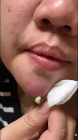 #satisfying #asmr #pimplepopping #pimplepopper #pimp #pimplepopperaddict  #satisfyingvideo #satisfyingvideos 