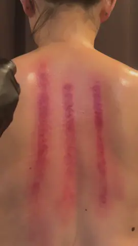 #cuppingmassage #asmrsounds #explore 