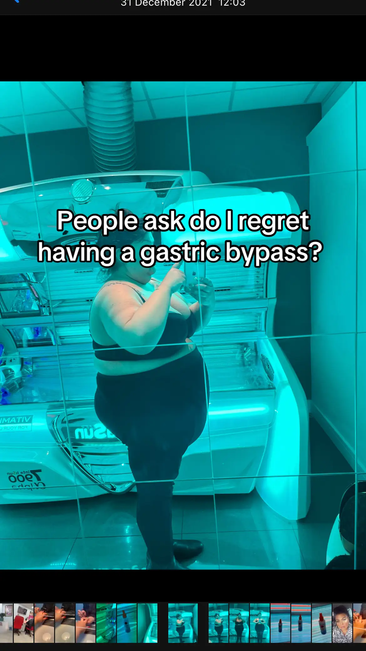 Gastric bypass #gastricbypass #bypass #surgery #gastricsurgery #weightloss #weightlosstransformation 