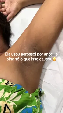 Sua axila escureceu e nada clareia? A verdade é que desodorantes com alumínio, como os em aerossol, podem causar escurecimento e acúmulo de resíduos na pele. Com o Peeling de Hollywood, a pele é renovada, mais clara, mais lisa e livre de impurezas. 📍 Atendimentos em São Luís – MA 📲 Clique no link da bio e agende sua avaliação #viralvideos #estetica #clareamentolaser #laserclarementoaxilas #arclinic #slz #esteticaemslz 