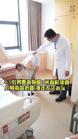 The 43-year-old male patient is 3.5 meters tall and has a stiff spine and a bent and folded upper body. He has been unable to raise his head for many years 🧑‍⚕️🏥🇨🇳🇺🇸 #SpinalEducation #NeurosurgeryTips #ScoliosisAwareness #HealthySpineTips #PhysicalTherapy #amazing #tiktok #family #fyp #doctor 