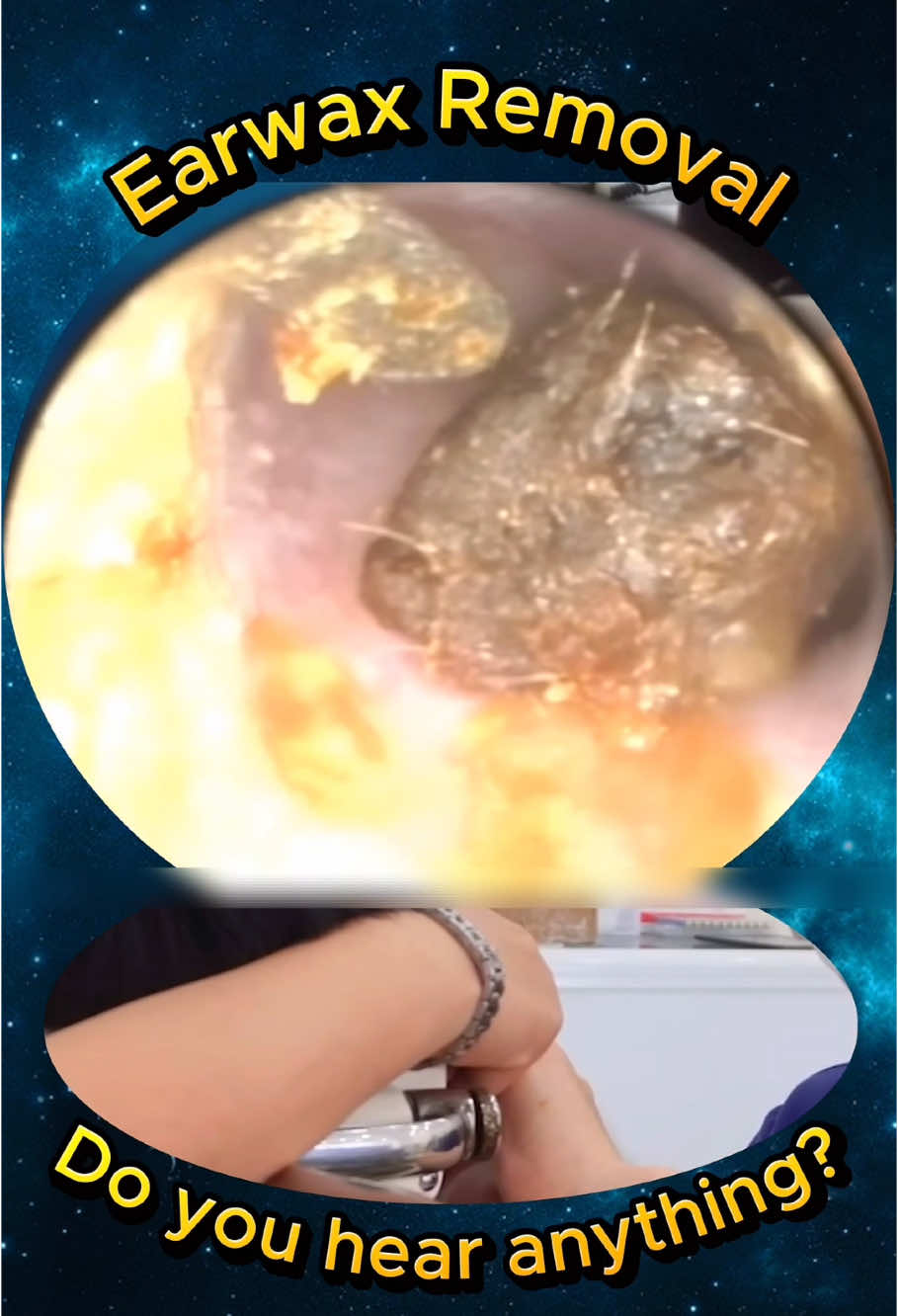 Does your ear look like this? #doctor #earwaxcleaning #earwax #ears #DIY 