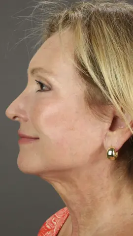 ✨ Facelift Transformation ✨ A subtle lift. A major glow-up. #FaceliftByDrNewman #NaturalResults #TemeculaPlasticSurgery #BeforeAndAfter