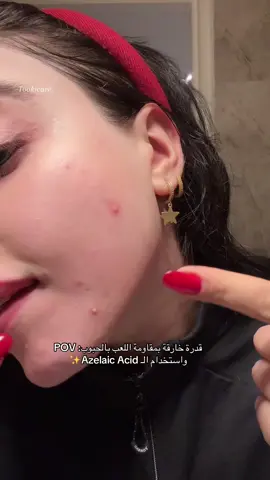 ⁨	الآثار الي تخلفها الحبوب من نلعب بيها هوايةةةةةةةةةة تطول وتضوج اكثر من الحبوب نفسها.  لازم متلعبون بيها ولا تفقعوها وتتركوها إلى تروح وحدها. كذلك كلش وجدا ينصح ب استخدام الالزلك  اسد -اياً كان نوعا- ويكون من ضمن الروتين لان الازلك اسد يعتبر من الخيارات الممتازة الي تساعد وي عدم انتشار البكتريا الي تسبّب حبوب وتقلل من الآثار الحمر والغامقة الي تصير بعد الحبوب، بالإضافة لكونة مقشر بسيط مناسب حتى للبشرات الحساسة جدا والوردية وهمين الحامل والمرضع. الي استخدمته بالفيديو هو مال انوا وراح انزل شرح مفصل عنه بالأيام الجاية ^^  . . #skincare #kbeauty #anua #azelaicacid #relatable #المغرب🇲🇦تونس🇹🇳الجزائر🇩🇿 #السعودية 