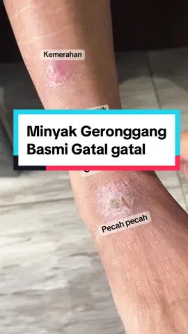 Buruan co sebelum kehabisan ‼️ #minyakgeronggang #obatgatal #fypシ 