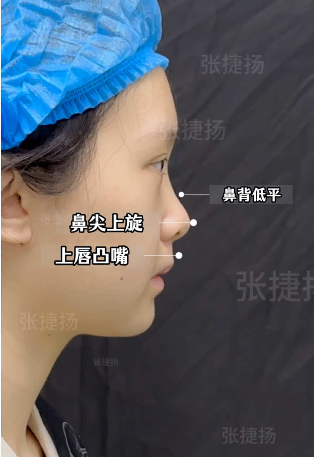 Having a nose job has changed my whole life.#整容 #逆袭 #rhinoplasty #变美 #隆鼻 