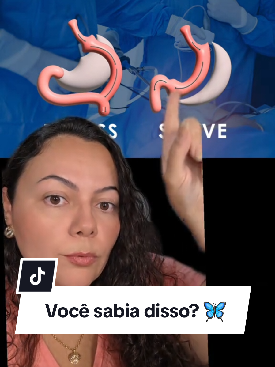 Qual técnica vocês fizeram?? 🦋 Vocês sabiam dessa diferença?!  #diariodeumabariatrica #bariatrica #sleevegastrectomy #emagrecimento 